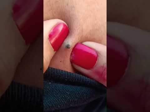 Giant Blackhead Removal from Back 0.1 !